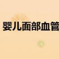 婴儿面部血管瘤（关于婴儿面部血管瘤简介）