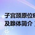 子宫颈原位癌累及腺体（关于子宫颈原位癌累及腺体简介）