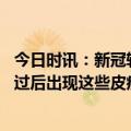 今日时讯：新冠转阴后出现肺炎或是继发细菌感染怎么办 阳过后出现这些皮疹需引起重视