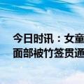 今日时讯：女童遭筷子戳眼直插大脑9厘米 石家庄1岁男童面部被竹签贯通刺伤