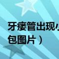 牙瘘管出现小脓包图片大全（牙瘘管出现小脓包图片）