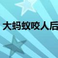 大蚂蚁咬人后怎么处理（被蚂蝗咬了怎么办）