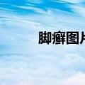 脚癣图片和症状图片（脚癣图片）