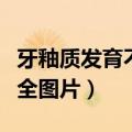 牙釉质发育不全图片重症图片（牙釉质发育不全图片）