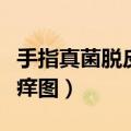 手指真菌脱皮开裂痒图片（手指真菌脱皮开裂痒图）