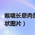 喉咙长息肉是什么病严重吗（喉咙长息肉的症状图片）