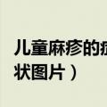 儿童麻疹的症状及治疗方法（儿童麻疹初期症状图片）