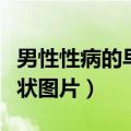 男性性病的早期症状图片大全（性病的早期症状图片）