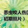 恙虫咬人伤口初期照片特效药（恙虫咬人伤口初期照片）