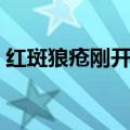 红斑狼疮刚开始图片（轻微过敏性紫癜图片）