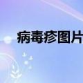 病毒疹图片和症状图片（病毒疹传染吗）