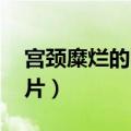 宫颈糜烂的图片真实 电灼术（宫颈糜烂的图片）
