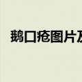 鹅口疮图片及症状图（鹅口疮图片及症状）
