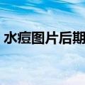 水痘图片后期图片（水痘图片初期是红点吗）
