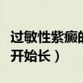 过敏性紫癜的最佳治疗方案（紫癜从哪个部位开始长）
