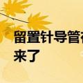 留置针导管在婴儿血管里漂移5年，终于取出来了