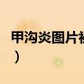 甲沟炎图片初期怎么形成（甲沟炎图片怎么治）