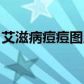 艾滋病痘痘图片初期 特点（艾滋病痘痘图片）