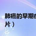 肺癌的早期症状图片女性（肺癌的早期症状图片）